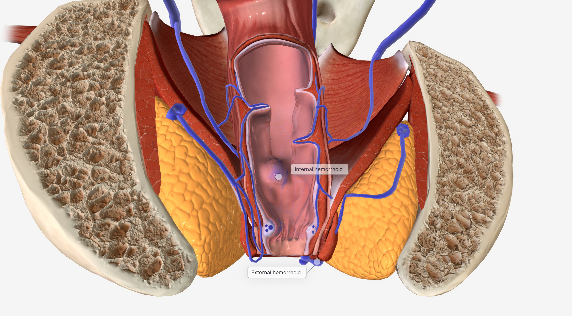 Hemorrhoids Meaning in Tamil